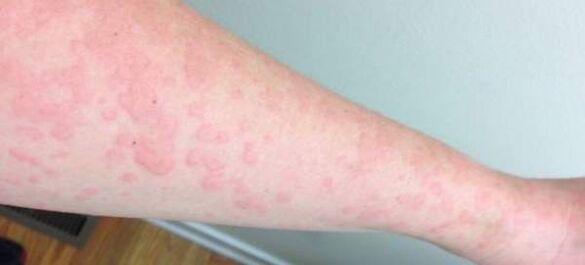 Larruazaleko alergiak gorputzean parasitoak egotearen seinale dira